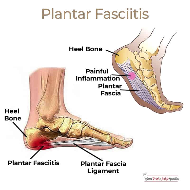 causes back of my heel pain
