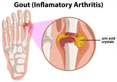 Gout Management