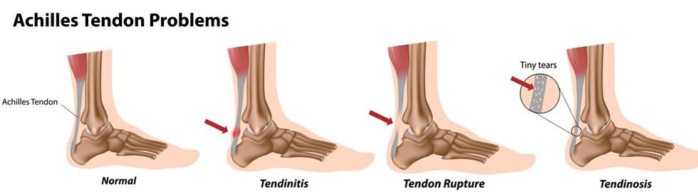Achilles Tendonitis, Symptoms and Treatment