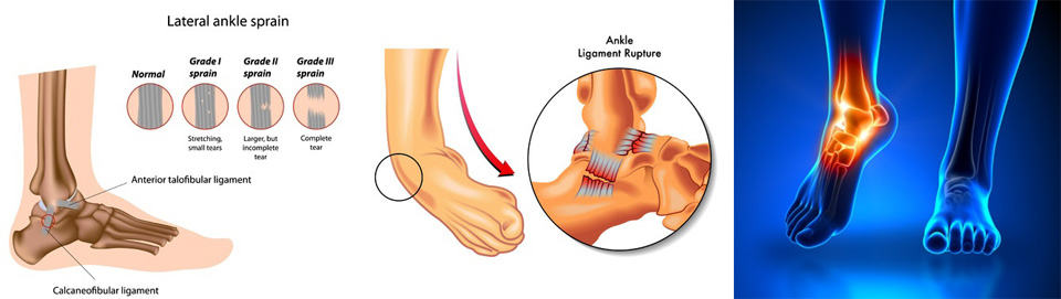 Ankle Instability, Ankle Sprains, Ankle Pain