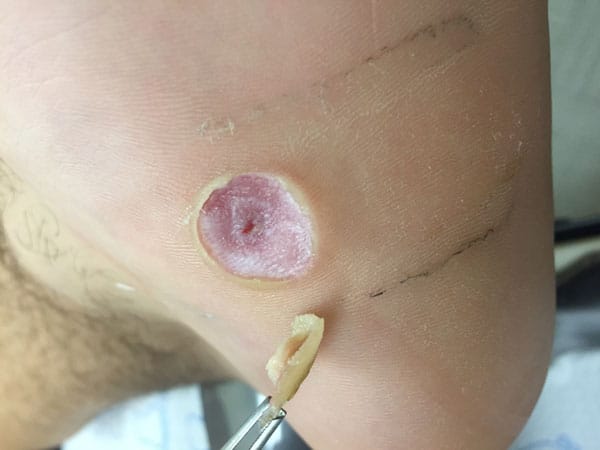 Wart on foot or blister