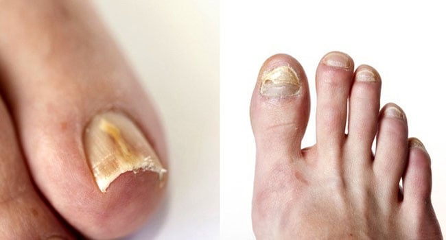 Why Are My Toenails Discolored Yellowed Thicker Dr Mikkel Jarman