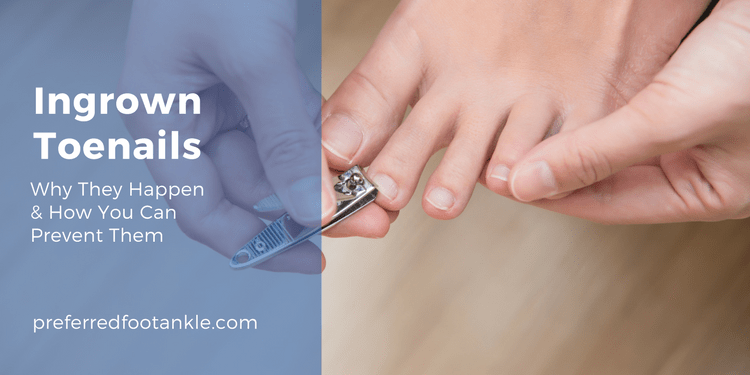 Ingrown Toenails – A Thorn in Your Side | Preferred Foot & Ankle