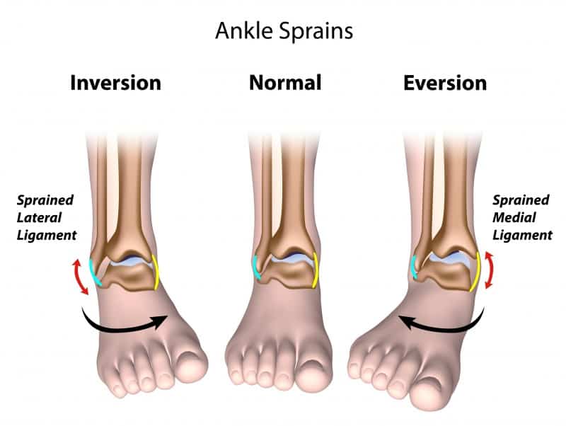 What Is An Ankle Sprain