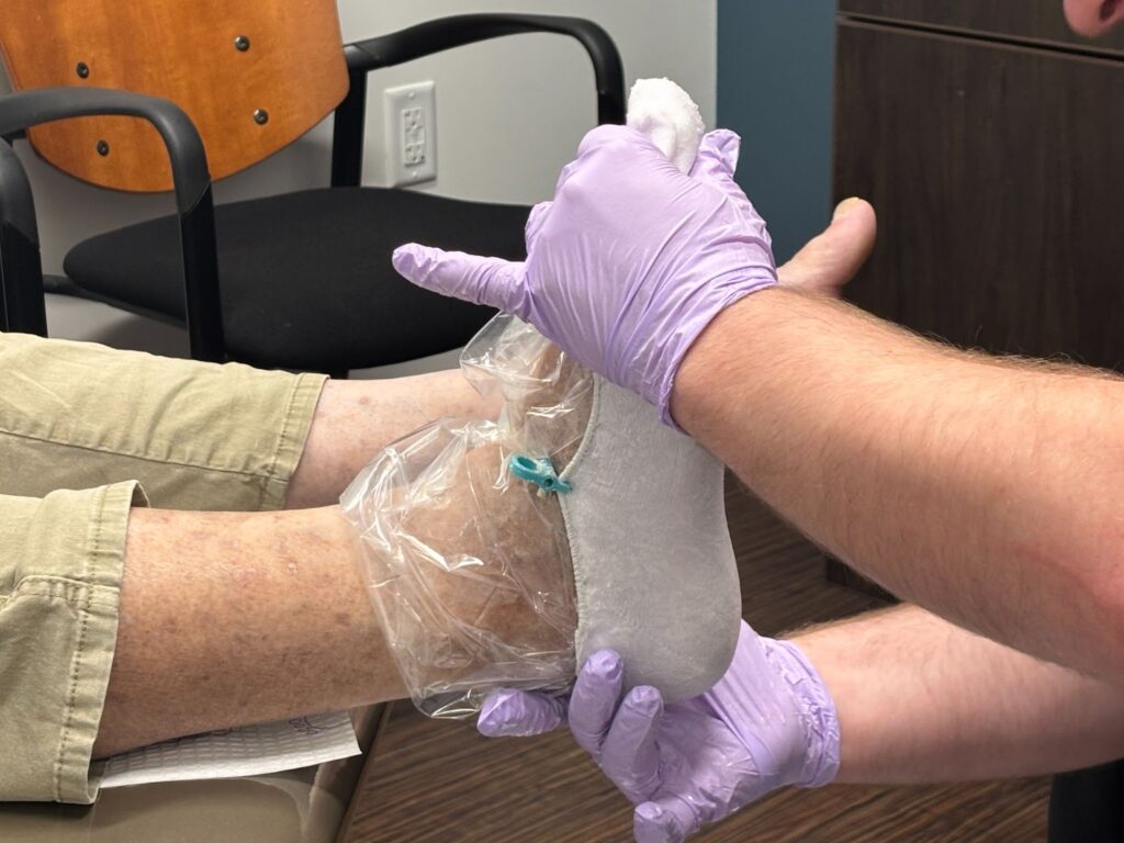 Bunions Are You Headed For Surgery