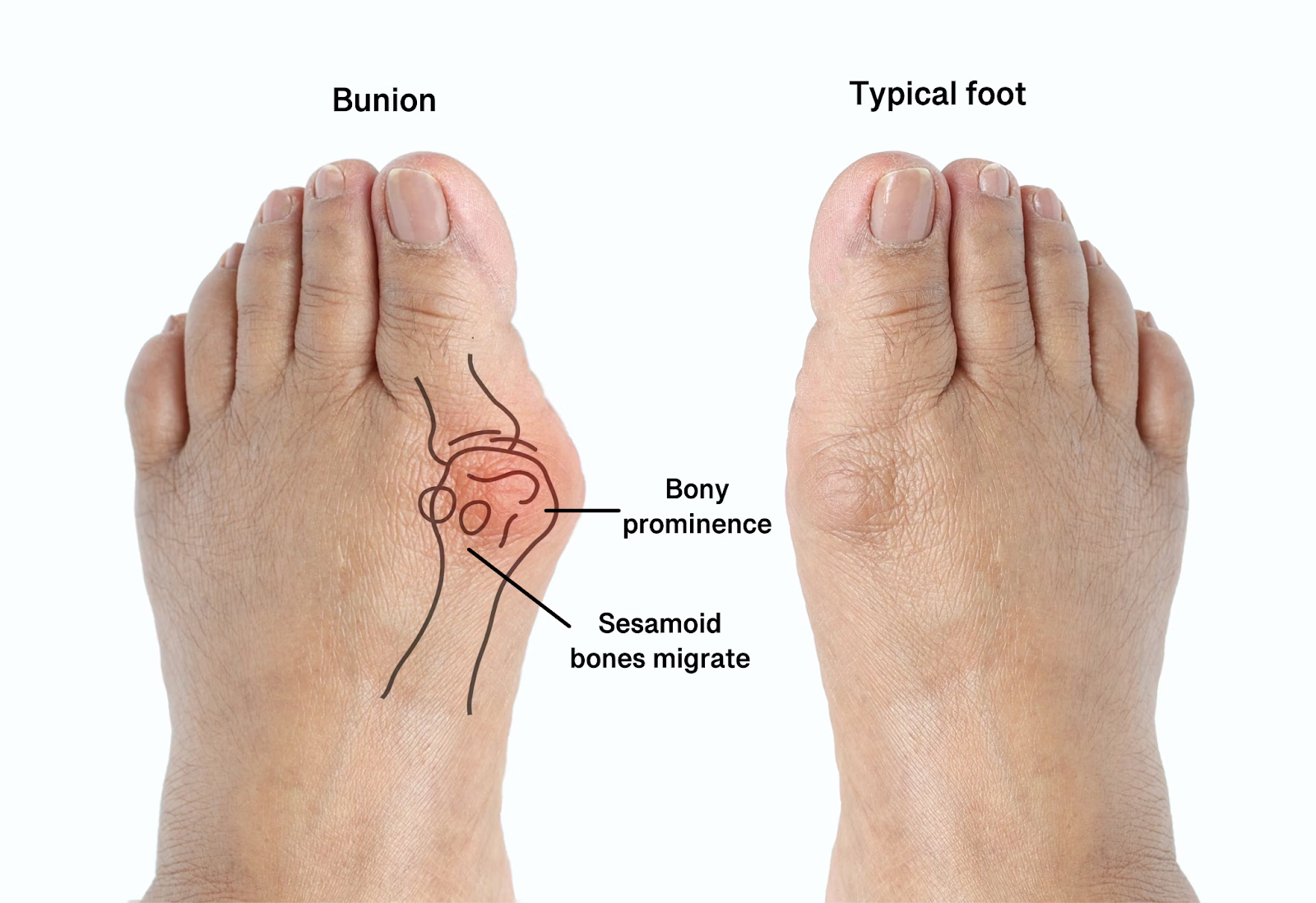 Bunions: Are You Headed For Surgery?