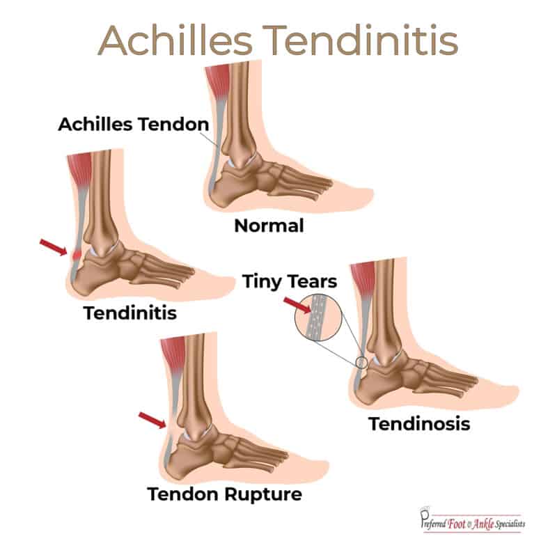 Common Causes of Heel Pain