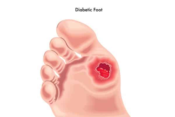 Diabetic Foot Problems - Foot Ulcer Illustration