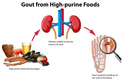 What Causes Gout