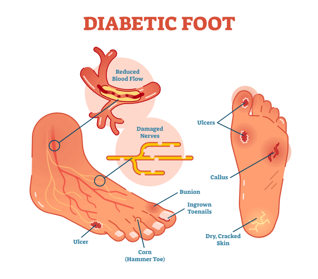 Foot Care Tips for Individuals with Diabetes