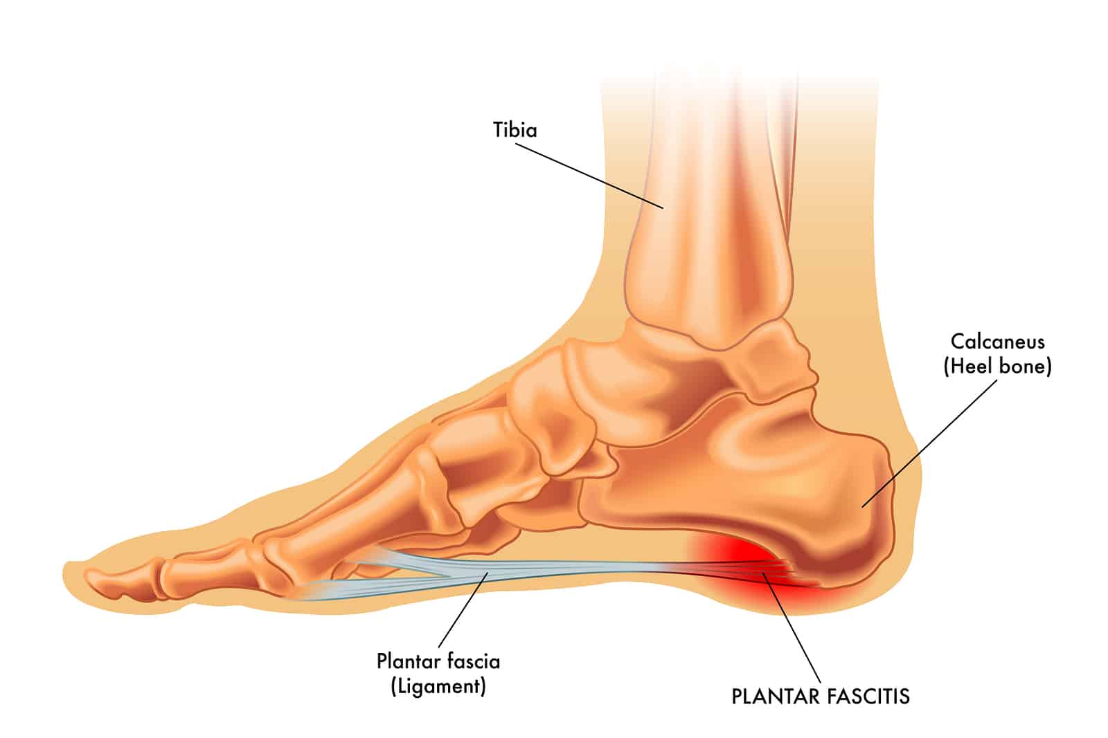 Vector medical illustration of symptoms of plantar fasciitis