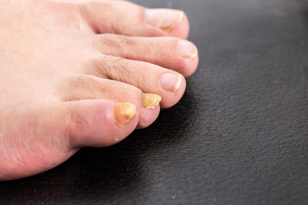 Why are My Toenails Discolored, Yellowed, Thicker? - Dr. Mikkel Jarman