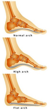 Fallen Arches and Flat Feet