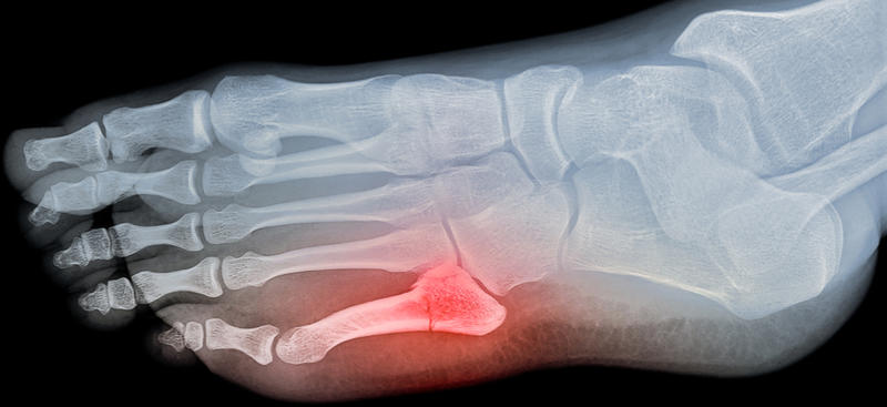broken foot x ray
