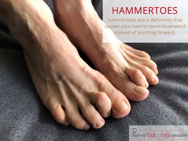 What Are Hammertoes