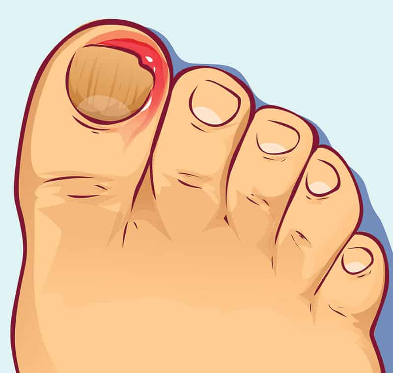 Ingrown Toenail