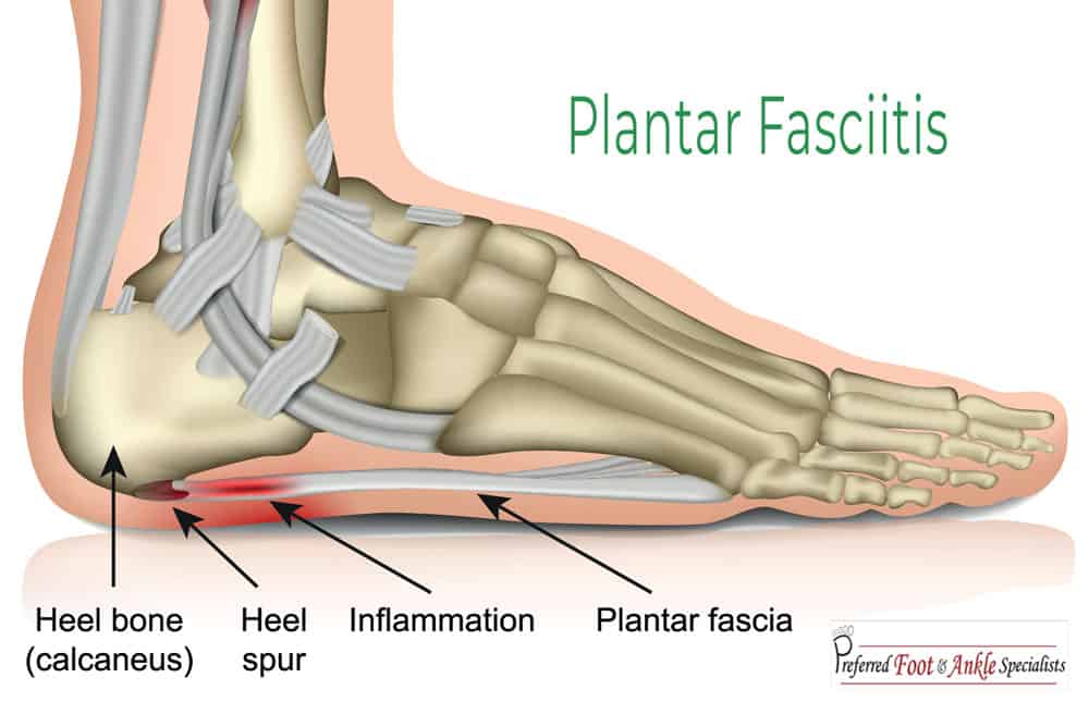 Plantar Fasciitis Treatment (Heel Pain) Preferred Foot & Ankle