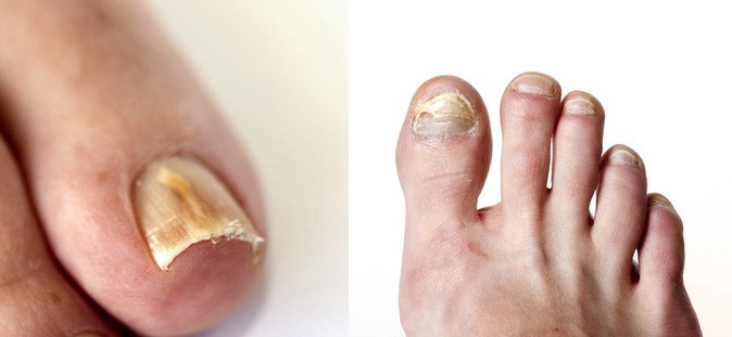 Toenail Fungus