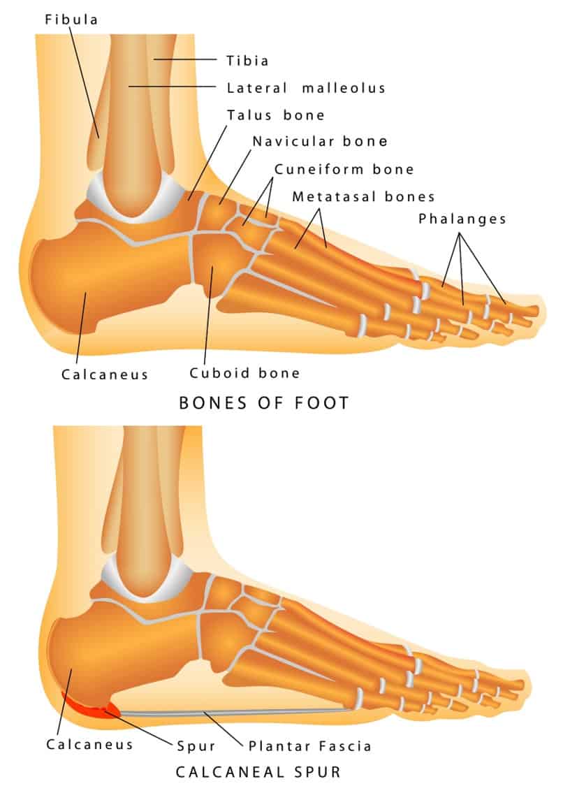 Bone spurs in heel relief online