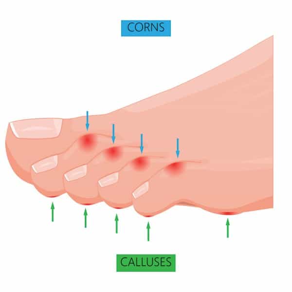 What Are Corns And Calluses