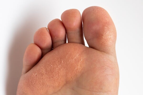 What Are Corns And Calluses