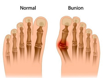 What Is A Bunion